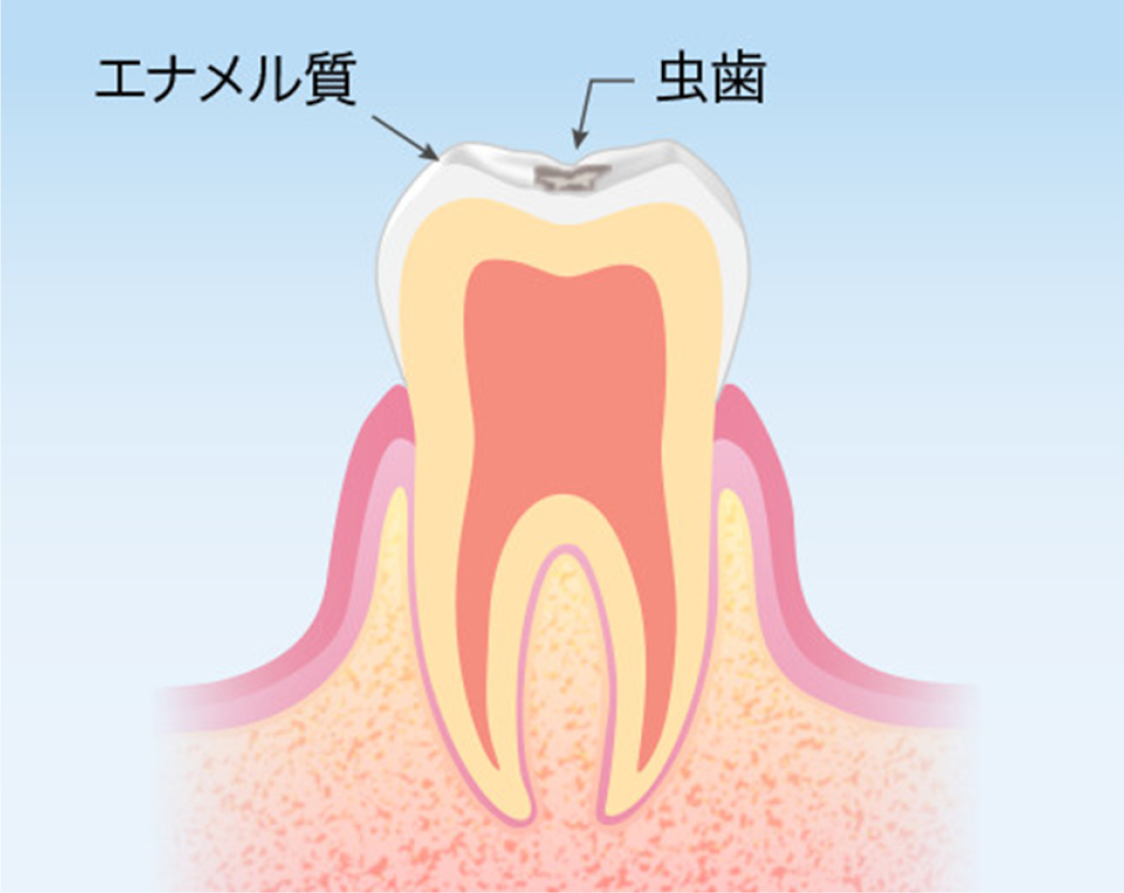 龍ケ崎・小野瀬歯科医院・むし歯(C1)